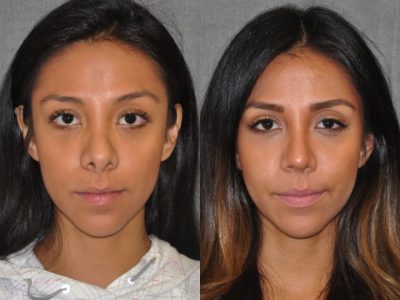 Revision Reconstruction Rhinoplasty - Front