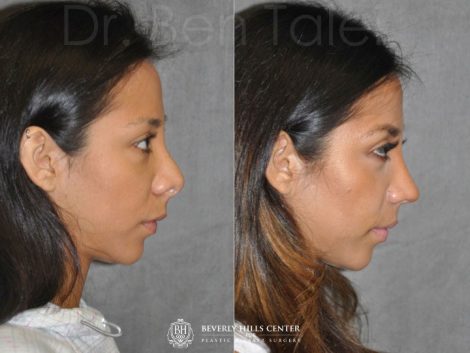 Revision Reconstruction Rhinoplasty - Right Side