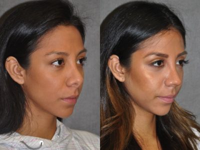 Revision Reconstruction Rhinoplasty - Right Side