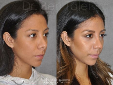 Revision Reconstruction Rhinoplasty - Right Side