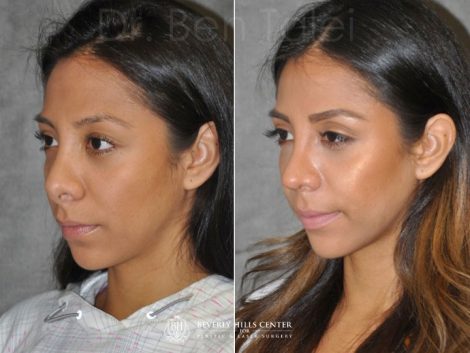 Beverly Hills Center Female Patient Before and After Revision Reconstruction Rhinoplasty Procedure