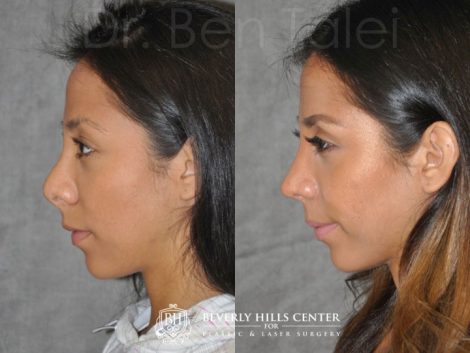 Beverly Hills Center Female Patient Before and After Revision Reconstruction Rhinoplasty Procedure