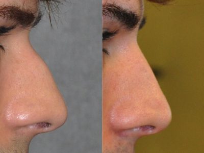 Non Surgical Liquid Rhinoplasty / Filler Nosejob