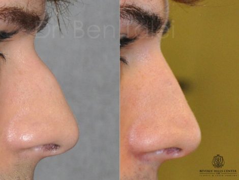 Non Surgical Liquid Rhinoplasty / Filler Nosejob