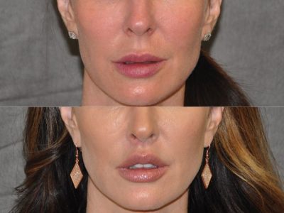 Modified Upper Lip Lift – Front