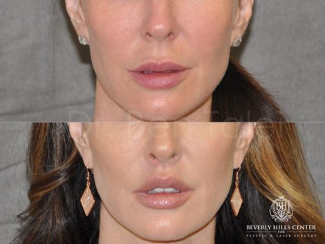 Modified Upper Lip Lift - Front
