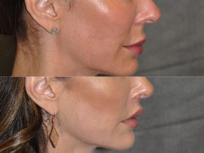Modified Upper Lip Lift – Right Side