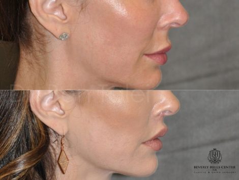 Modified Upper Lip Lift - Right Side