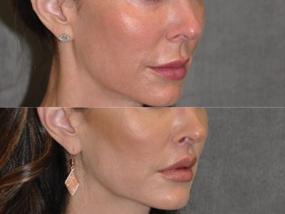 Modified Upper Lip Lift – Right Side