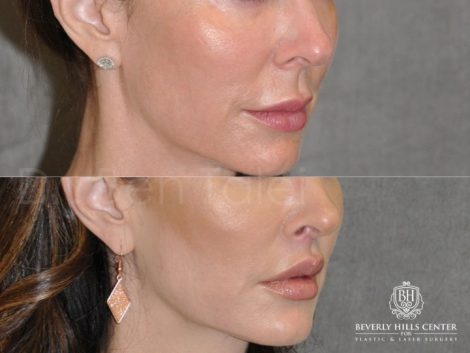 Modified Upper Lip Lift - Right Side