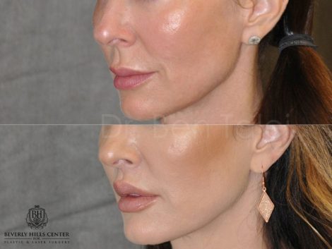 Modified Upper Lip Lift - Left Side