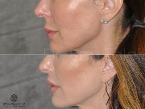Modified Upper Lip Lift - Left Side