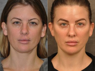 MiniLift / Neck Lift with cheek fillers and dysport – Front