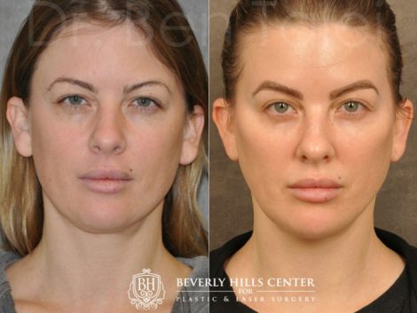 MiniLift / Neck Lift with cheek fillers and dysport – Front