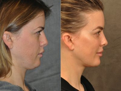 MiniLift / Neck Lift with cheek fillers and dysport – Right Side