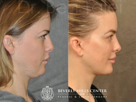 MiniLift / Neck Lift with cheek fillers and dysport – Right Side