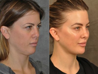 MiniLift / Neck Lift with cheek fillers and dysport – Right Side
