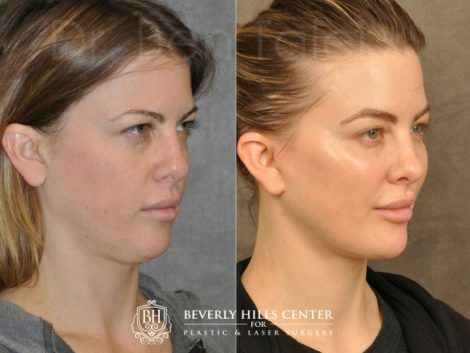 MiniLift / Neck Lift with cheek fillers and dysport – Right Side
