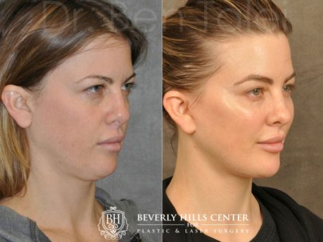 MiniLift / Neck Lift with cheek fillers and dysport – Right Side