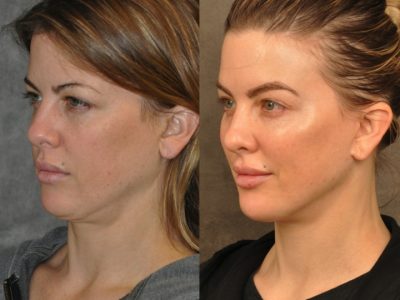 MiniLift / Neck Lift with cheek fillers and dysport – Left Side