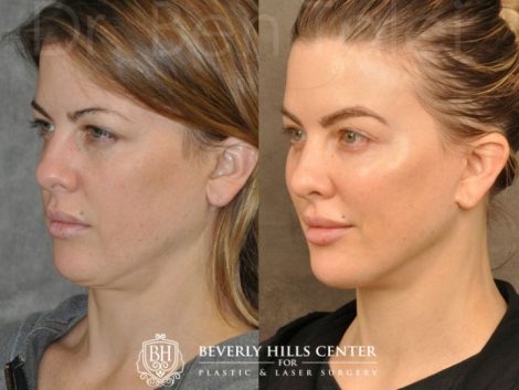 MiniLift / Neck Lift with cheek fillers and dysport – Left Side