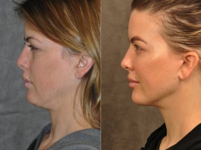 MiniLift / Neck Lift with cheek fillers and dysport – Left Side