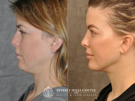 MiniLift / Neck Lift with cheek fillers and dysport – Left Side