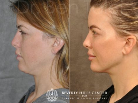 MiniLift / Neck Lift with cheek fillers and dysport – Left Side