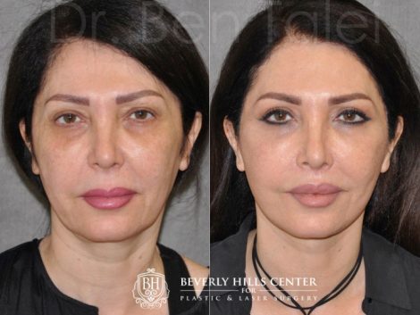 AuraLyft & Lip Lift with Upper Eyelid Rejuvenation - Front