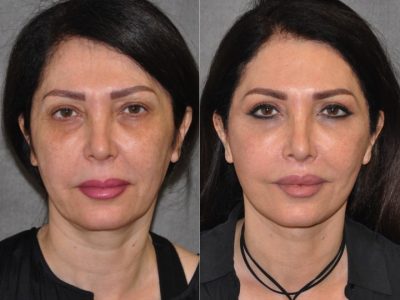 AuraLyft & Lip Lift with Upper Eyelid Rejuvenation - Front