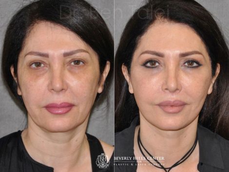 AuraLyft & Lip Lift with Upper Eyelid Rejuvenation - Front