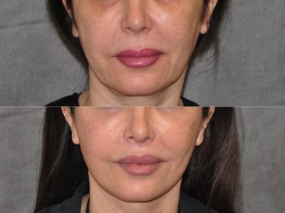 AuraLyft & Lip Lift with Upper Eyelid Rejuvenation - Front