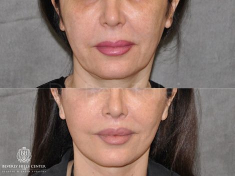AuraLyft & Lip Lift with Upper Eyelid Rejuvenation - Front