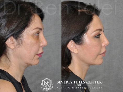 AuraLyft & Lip Lift with Upper Eyelid Rejuvenation - Right Side