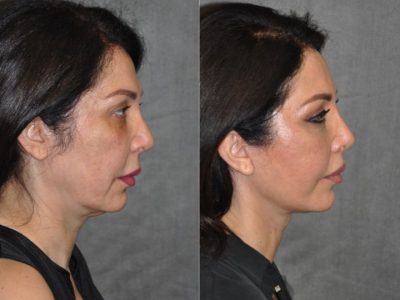 AuraLyft & Lip Lift with Upper Eyelid Rejuvenation - Right Side