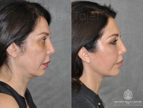 AuraLyft & Lip Lift with Upper Eyelid Rejuvenation - Right Side