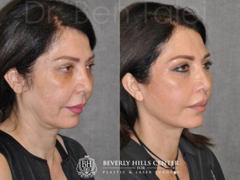 AuraLyft & Lip Lift with Upper Eyelid Rejuvenation - Right Side