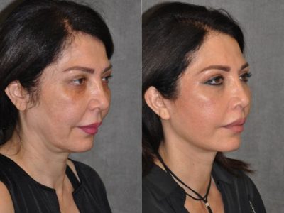 AuraLyft & Lip Lift with Upper Eyelid Rejuvenation - Right Side