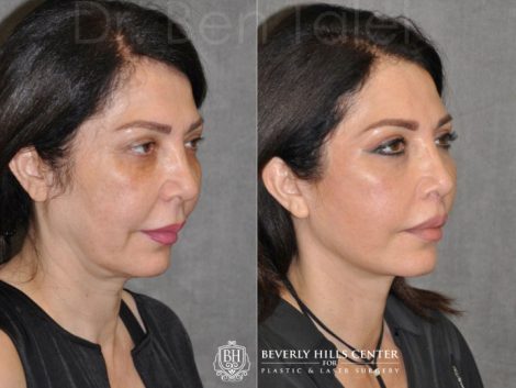 AuraLyft & Lip Lift with Upper Eyelid Rejuvenation - Right Side