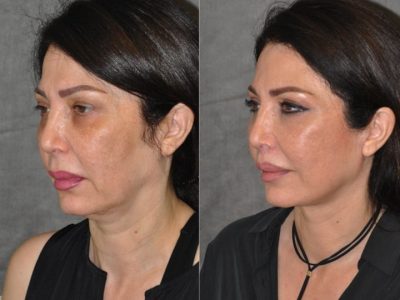AuraLyft & Lip Lift with Upper Eyelid Rejuvenation - Left Side
