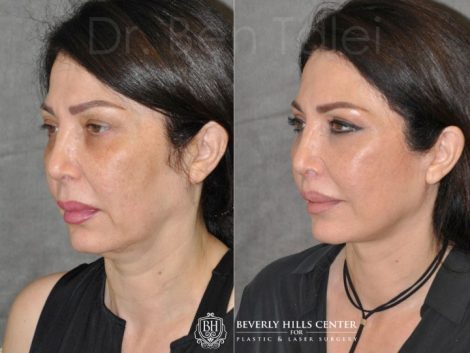 AuraLyft & Lip Lift with Upper Eyelid Rejuvenation - Left Side