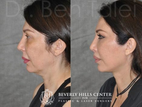 AuraLyft & Lip Lift with Upper Eyelid Rejuvenation - Left Side