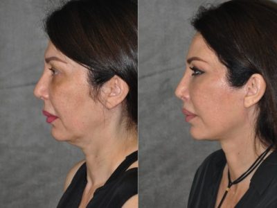 AuraLyft & Lip Lift with Upper Eyelid Rejuvenation - Left Side