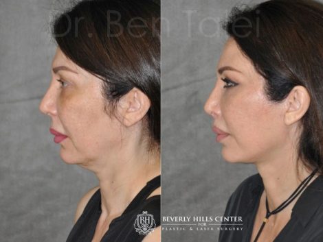 AuraLyft & Lip Lift with Upper Eyelid Rejuvenation - Left Side