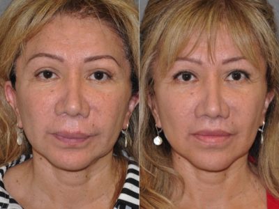 Corrective Modified Upper Lip Lift and Lip Border Revision - Front
