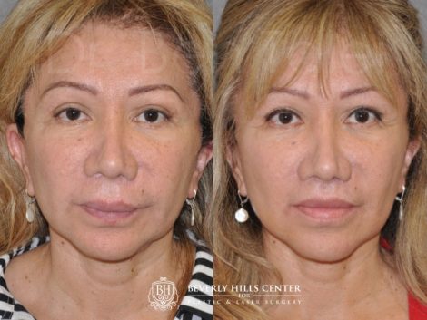 Corrective Modified Upper Lip Lift and Lip Border Revision - Front