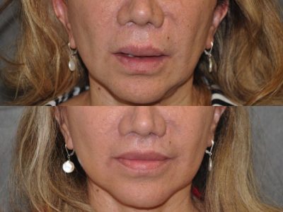 Corrective Modified Upper Lip Lift and Lip Border Revision - Front