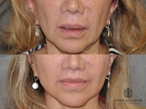 Corrective Modified Upper Lip Lift and Lip Border Revision - Front