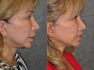Corrective Modified Upper Lip Lift and Lip Border Revision - Right Side