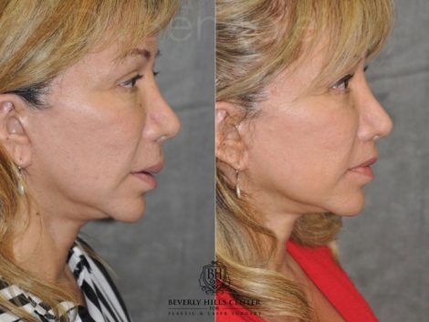Corrective Modified Upper Lip Lift and Lip Border Revision - Right Side